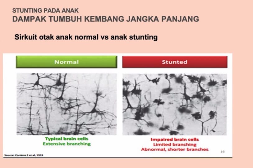 perbandingan saraf otak anak normal dan otak anak penderita stunting